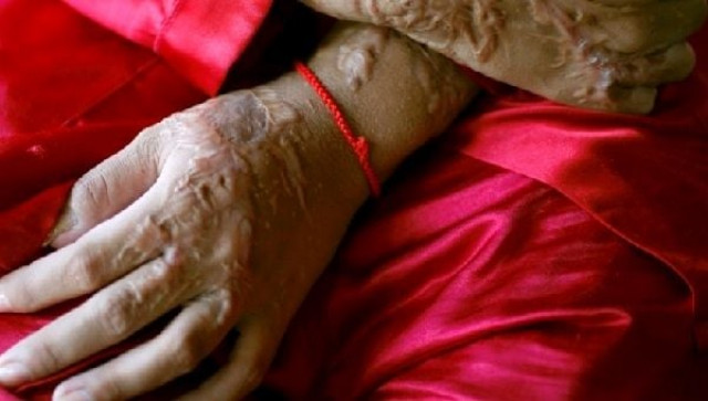 National Assembly Passes Tough Acid, Burn Attack Law